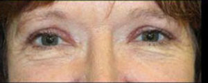 Blepharoplasty Before and After Pictures Pittsburgh, PA