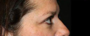Blepharoplasty Before and After Pictures Pittsburgh, PA