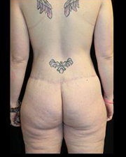 Body Lift Before and After Pictures Pittsburgh, PA