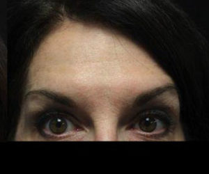 Botox® Before and After Pictures Pittsburgh, PA