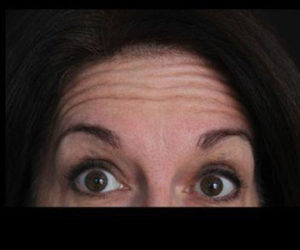 Botox® Before and After Pictures Pittsburgh, PA
