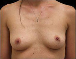 Breast Augmentation Before and After Pictures Pittsburgh, PA