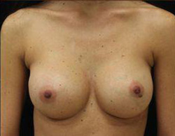 Breast Augmentation Before and After Pictures Pittsburgh, PA