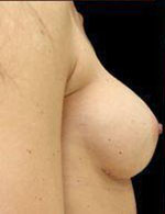Breast Augmentation Before and After Pictures Pittsburgh, PA