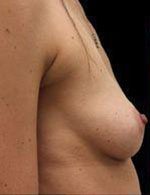 Breast Augmentation Before and After Pictures Pittsburgh, PA