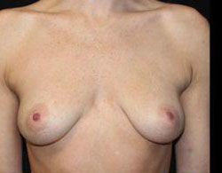 Breast Augmentation Before and After Pictures Pittsburgh, PA