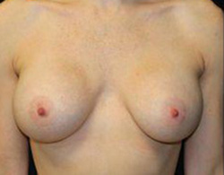 Breast Augmentation Before and After Pictures Pittsburgh, PA