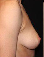 Breast Augmentation Before and After Pictures Pittsburgh, PA