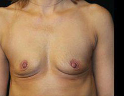 Breast Augmentation Before and After Pictures Pittsburgh, PA