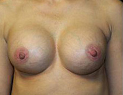 Breast Augmentation Before and After Pictures Pittsburgh, PA