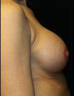 Breast Augmentation Before and After Pictures Pittsburgh, PA