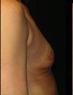 Breast Augmentation Before and After Pictures Pittsburgh, PA