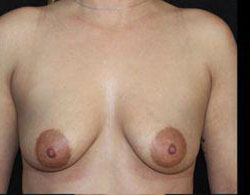 Breast Augmentation Before and After Pictures Pittsburgh, PA