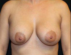 Breast Augmentation Before and After Pictures Pittsburgh, PA