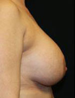 Breast Augmentation Before and After Pictures Pittsburgh, PA