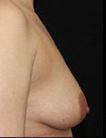 Breast Augmentation Before and After Pictures Pittsburgh, PA