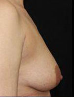 Breast Augmentation Before and After Pictures Pittsburgh, PA