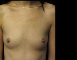 Breast Augmentation Before and After Pictures Pittsburgh, PA