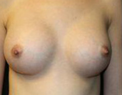 Breast Augmentation Before and After Pictures Pittsburgh, PA