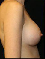 Breast Augmentation Before and After Pictures Pittsburgh, PA