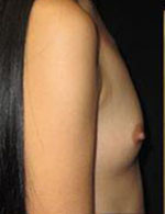 Breast Augmentation Before and After Pictures Pittsburgh, PA