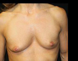 Breast Augmentation Before and After Pictures Pittsburgh, PA