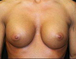 Breast Augmentation Before and After Pictures Pittsburgh, PA