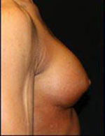 Breast Augmentation Before and After Pictures Pittsburgh, PA