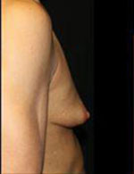 Breast Augmentation Before and After Pictures Pittsburgh, PA