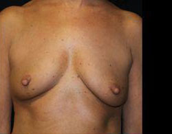 Breast Augmentation Before and After Pictures Pittsburgh, PA