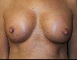 Breast Augmentation Before and After Pictures Pittsburgh, PA