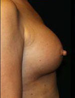 Breast Augmentation Before and After Pictures Pittsburgh, PA