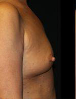 Breast Augmentation Before and After Pictures Pittsburgh, PA