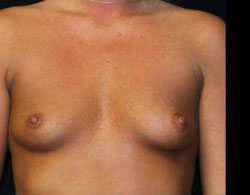 Breast Augmentation Before and After Pictures Pittsburgh, PA