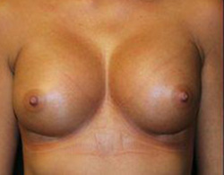 Breast Augmentation Before and After Pictures Pittsburgh, PA