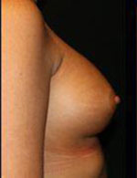 Breast Augmentation Before and After Pictures Pittsburgh, PA