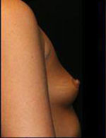 Breast Augmentation Before and After Pictures Pittsburgh, PA