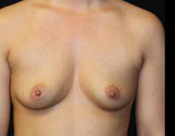 Breast Augmentation Before and After Pictures Pittsburgh, PA