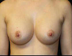 Breast Augmentation Before and After Pictures Pittsburgh, PA