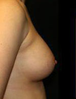 Breast Augmentation Before and After Pictures Pittsburgh, PA