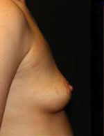 Breast Augmentation Before and After Pictures Pittsburgh, PA