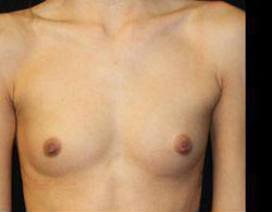 Breast Augmentation Before and After Pictures Pittsburgh, PA