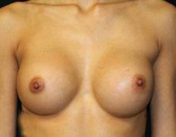 Breast Augmentation Before and After Pictures Pittsburgh, PA