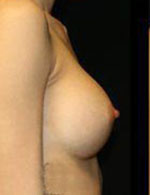 Breast Augmentation Before and After Pictures Pittsburgh, PA