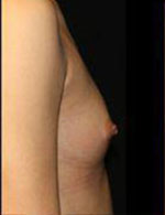 Breast Augmentation Before and After Pictures Pittsburgh, PA