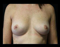 Breast Augmentation Before and After Pictures Pittsburgh, PA