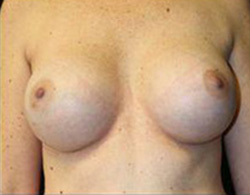 Breast Augmentation Before and After Pictures Pittsburgh, PA