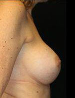 Breast Augmentation Before and After Pictures Pittsburgh, PA