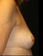 Breast Augmentation Before and After Pictures Pittsburgh, PA