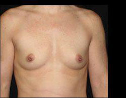 Breast Augmentation Before and After Pictures Pittsburgh, PA